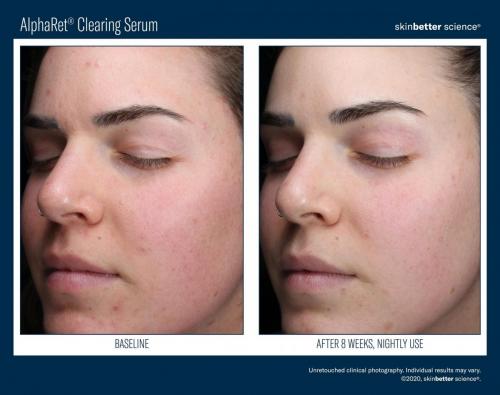 AlphaRet Clearing Serum Before _ After Template_2020(HQP)3