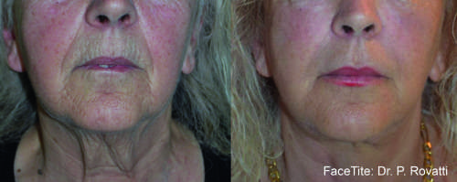 Nasolabial folds proof 1